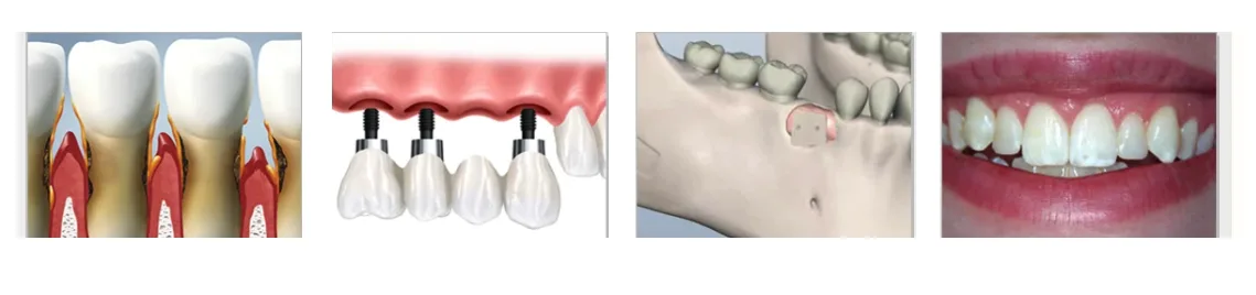 Common periodontal procedures: periodontal disease, dental implants, gum and bone grafting, and esthetic crown lengthening