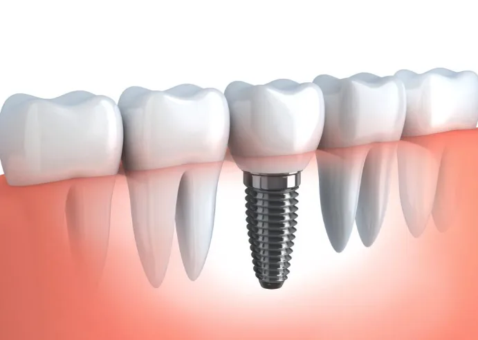 Dental implant placed in the jawbone